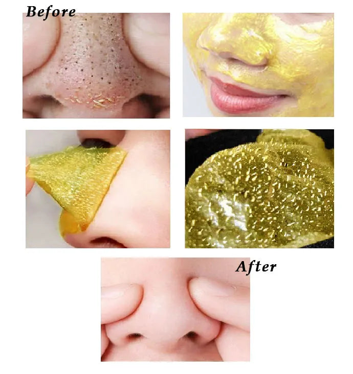 24K Gold Mask - Blackheads & Acne Removal